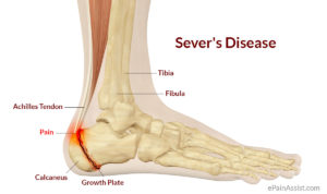 Key signs of Sever’s Disease