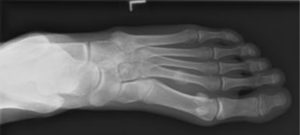 Signs of a Stress Fracture in the Foot