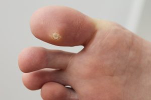 Foot with verruca and warts