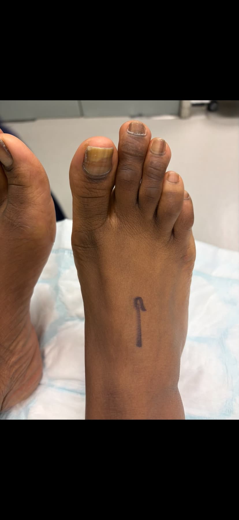 Hammertoe after surgery - toe straightened and corrected
