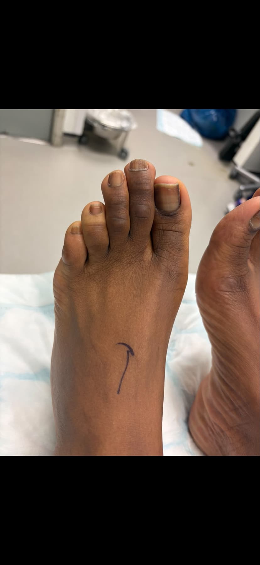 Hammertoe after surgery - showing heel and corrected toe alignment
