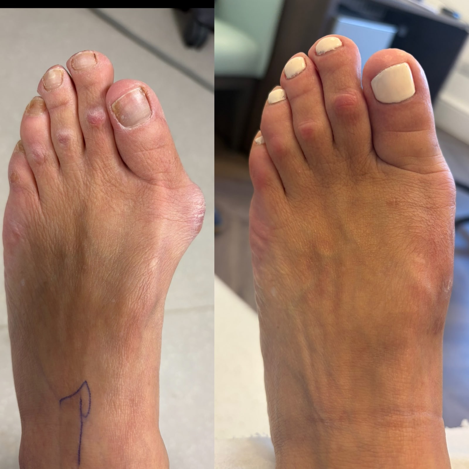 Before and after bunion surgery results showing permanent correction and improved foot appearance