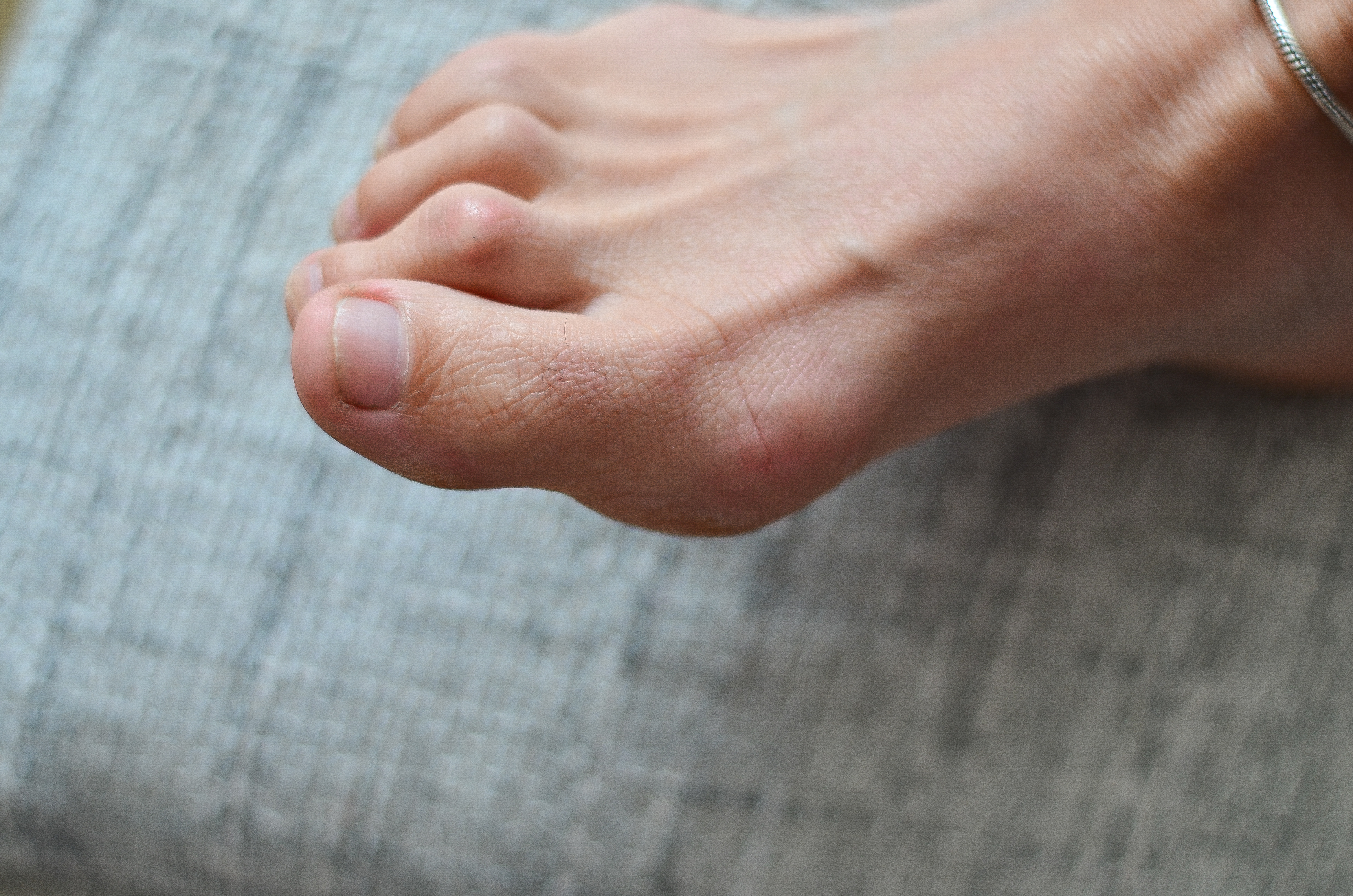 Hammer, Claw, and Mallet Toes - Explore the Differences