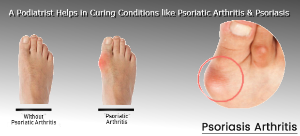 Why do we get hard skin on our big toes? - Active Care Podiatry