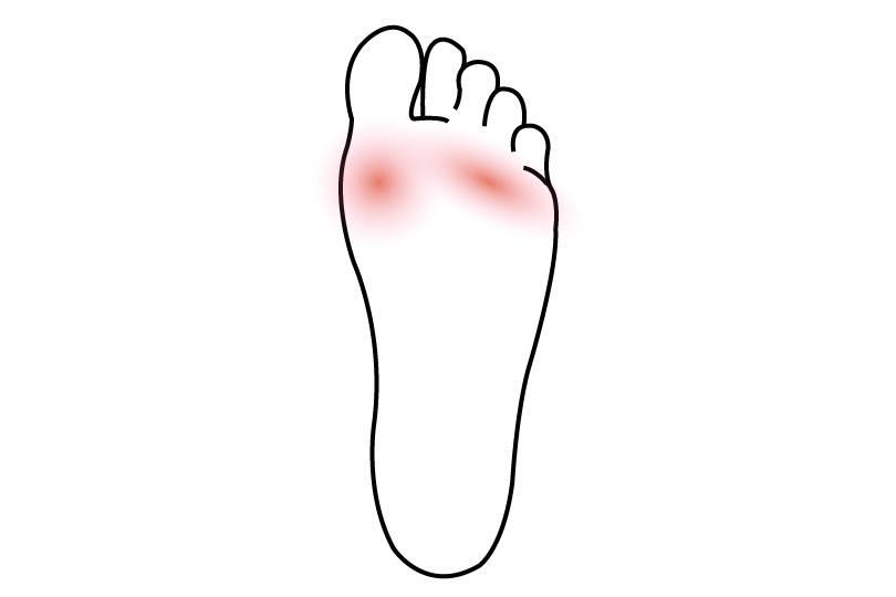 Pain Ball of Foot  Cause of Pain in the Ball of Foot