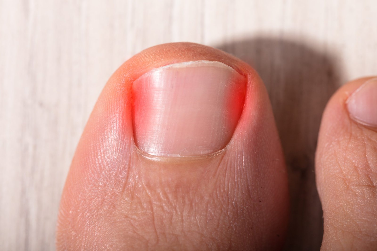 Ingrown Toenail Treatment & Remedies for Ingrown Toenails​