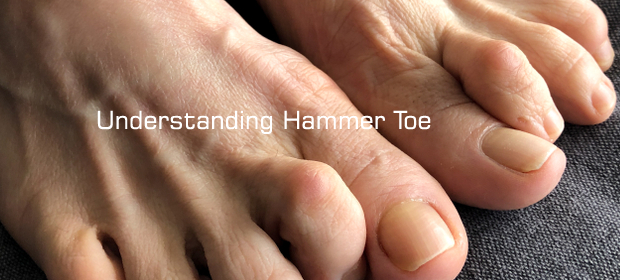 Hammer Toes  Diagnosis, Causes & Treatments